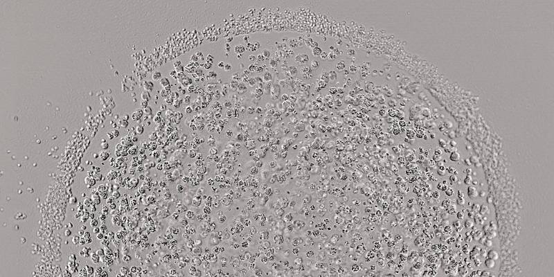 A tumoroid, colon cancer cells grown in 3D